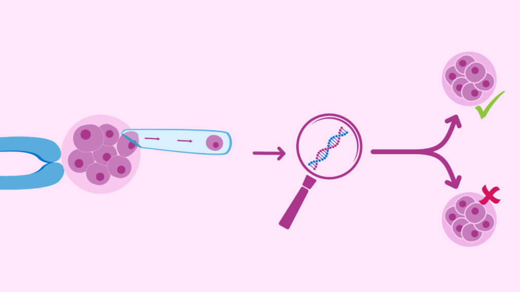 Zapłodnienie in vitro + progestagen w Iranie