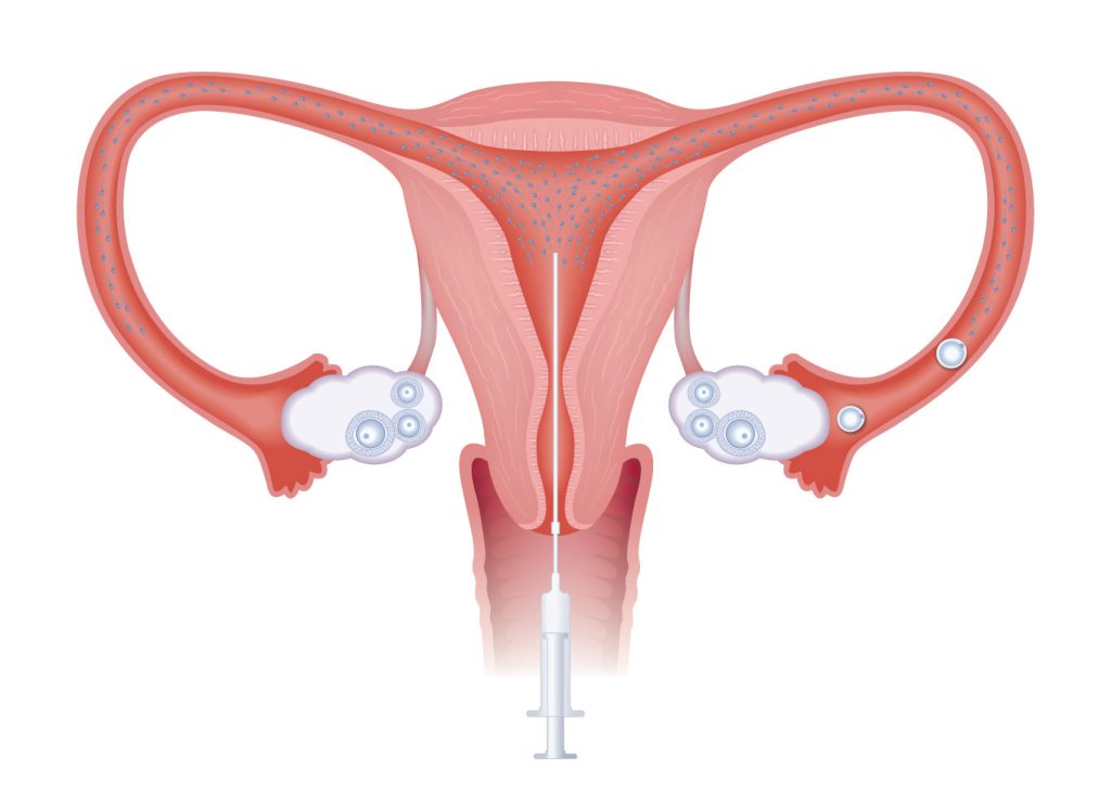 IUI inseminacja domaciczna